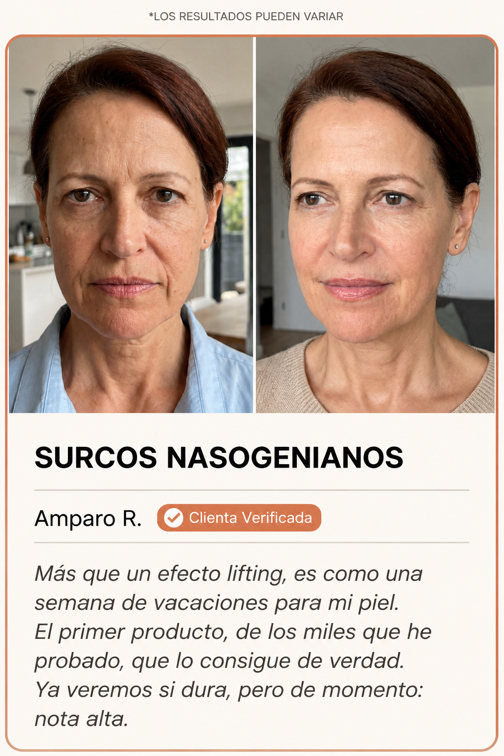 Surcos nasogenianos antes y después